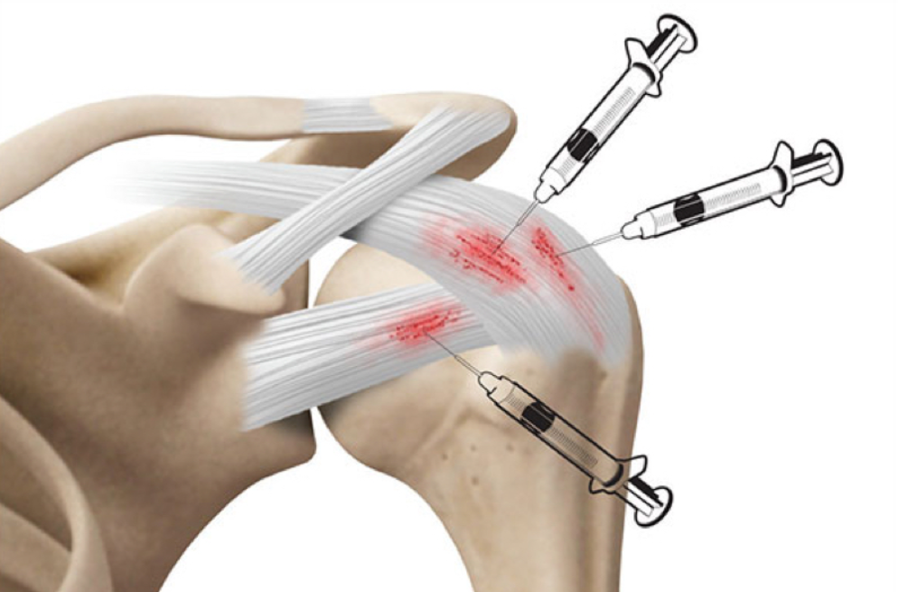 주사치료 설명 이미지