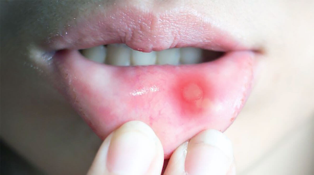 “구내염-원인”