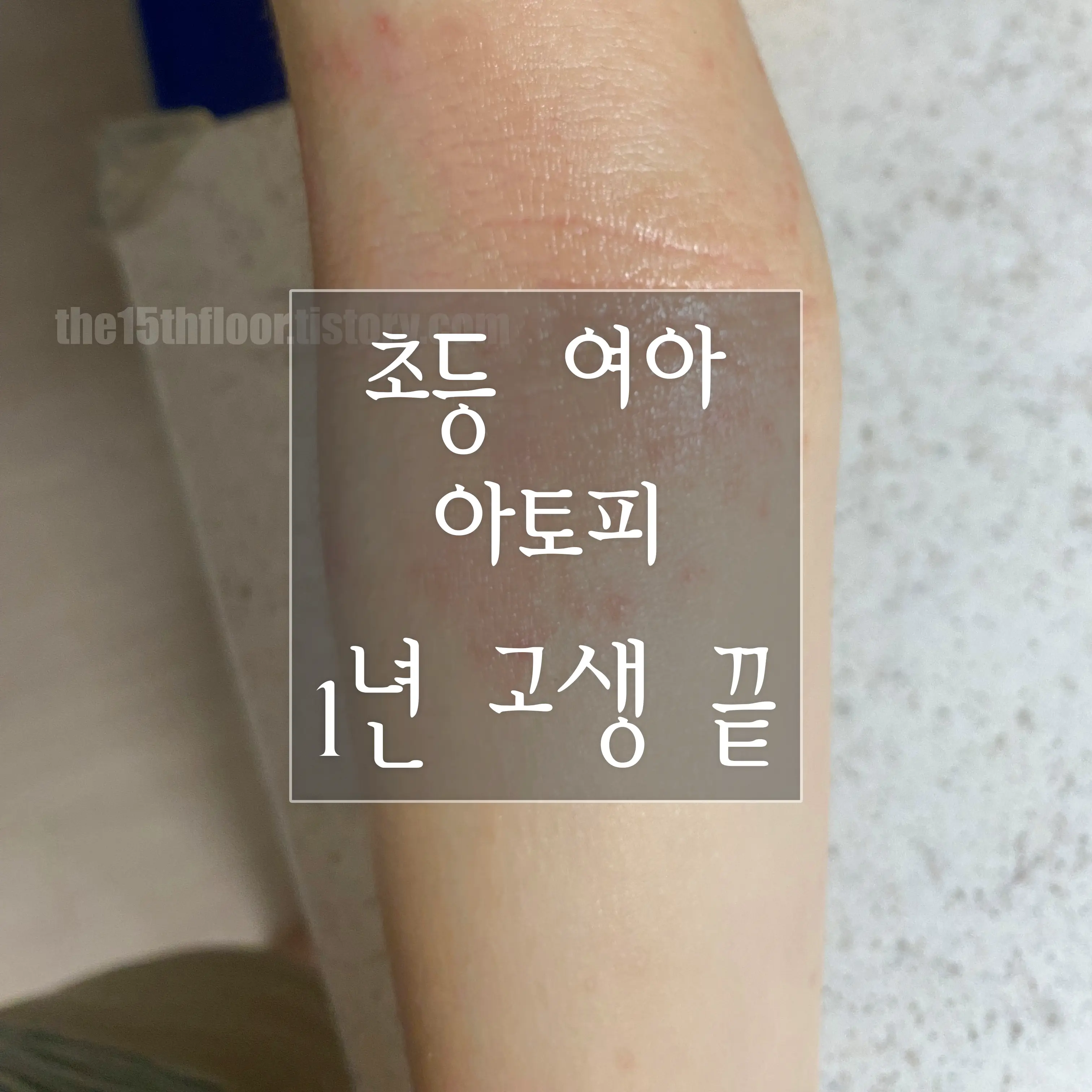 아토피 1년 고생 끝