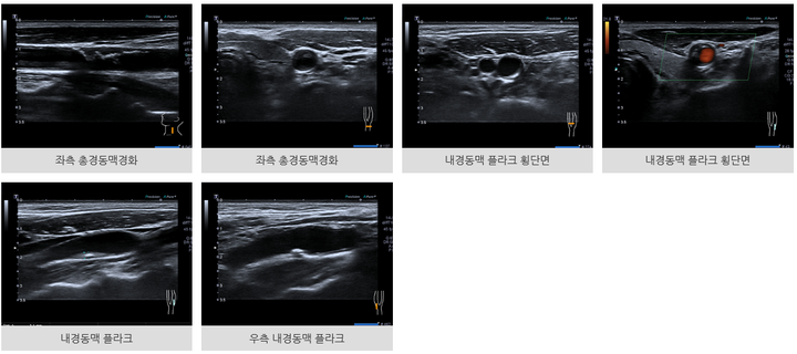 경동맥 초음파