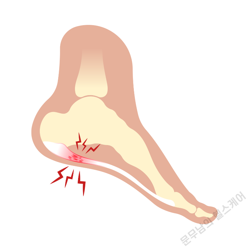 족저근막염 증상