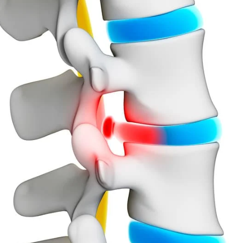 허리디스크에 좋은 운동 증상 치료법 알아보기