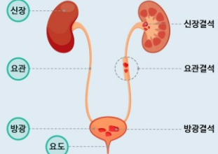 쏘팔메토의 효능 