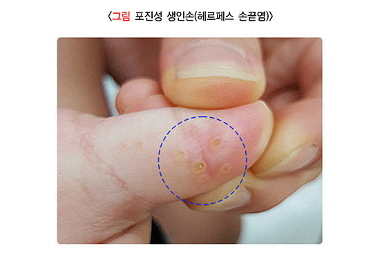 포진성생인손