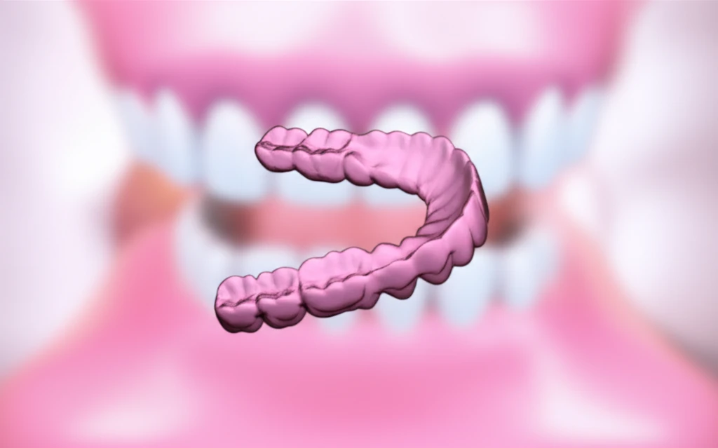 틀니 종류별 완벽 비교 아크릴, 금속