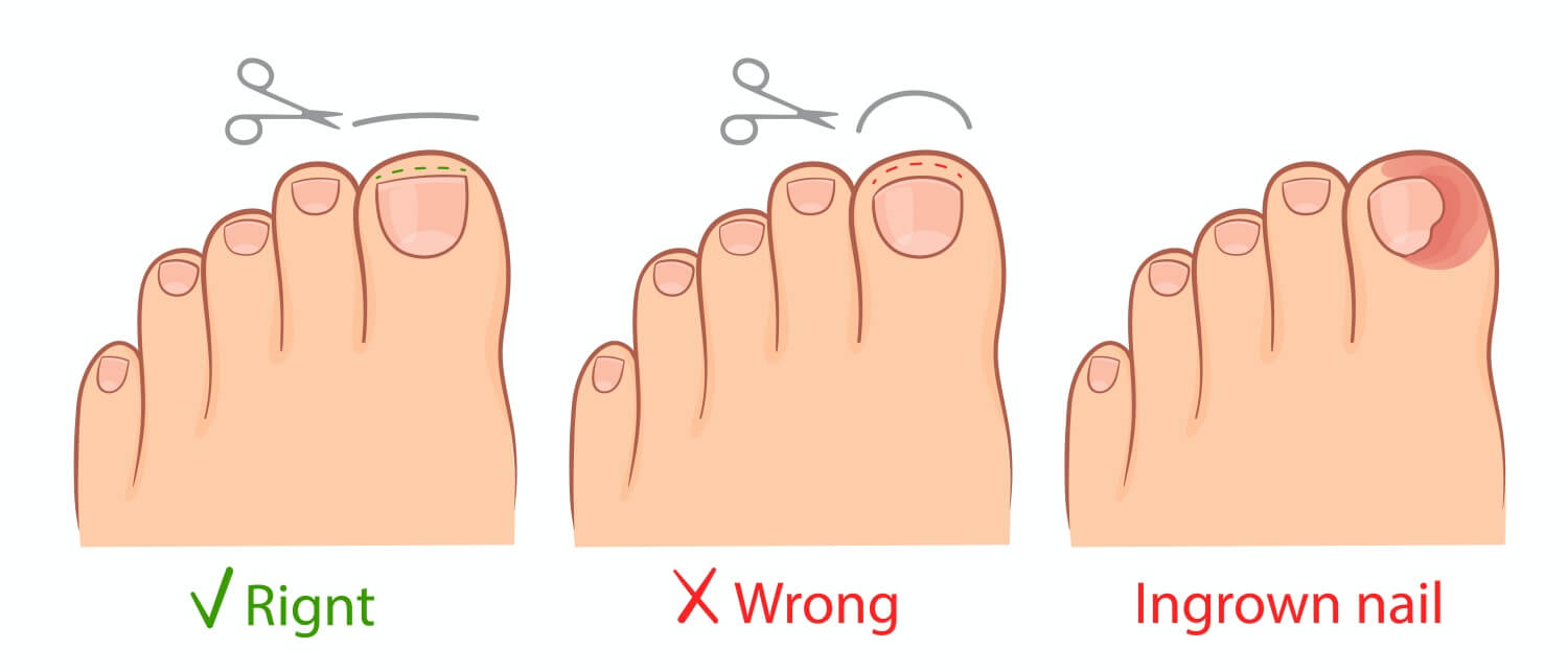올바른-발톱자르는-방법과-내성발톱