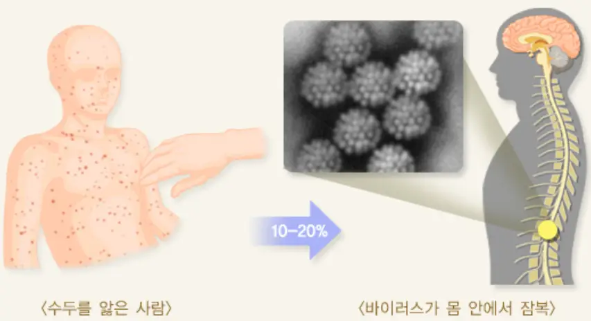 수두-바이러스진행-이미지