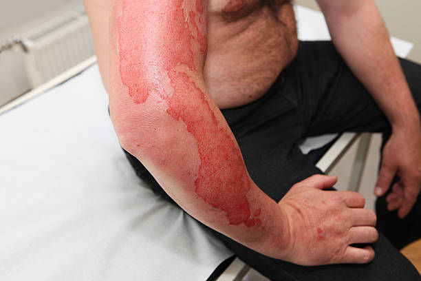 저온화상 증상 단계별 특징