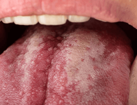 칸디다증 칸디다 감염 칸디다 치료 칸디다 증상 부위별 키워드 구강 칸디다증 (아구창) 질 칸디다증 피부 칸디다 식도 칸디다 칸디다 골관절염 칸디다 복막염 간비장 칸디다증 원인 및 치료 관련 키워드 칸디다증 원인 칸디다 감염 원인 칸디다증 치료법 칸디다 연고 칸디다 항진균제 칸디다증 면역력 강화 예방 및 생활습관 키워드 칸디다증 예방 칸디다에 좋은 음식 칸디다에 좋은 습관 항생제 부작용 칸디다 음식 관련 키워드 칸디다증에 좋은 음식 칸디다 억제 식품 마늘 칸디다 억제 칸디다 녹황색 채소 오메가3 칸디다 기타 연관 키워드 칸디다 전염성 칸디다증 생활 습관 칸디다증 자가진단 칸디다 곰팡이 감염 칸디다증 면역력