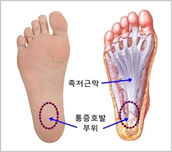 발바닥통증의 원인들과 해결책_15