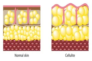 셀룰라이트-없애는-법