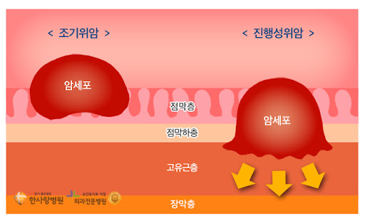 명의 위암 증상 예방 식품 식습관 생존율