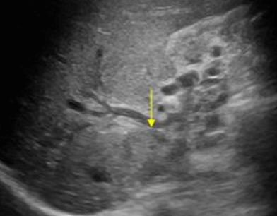 간문부 담관암(Klatskin's tumor = Hilar cholagiocarcinoma)