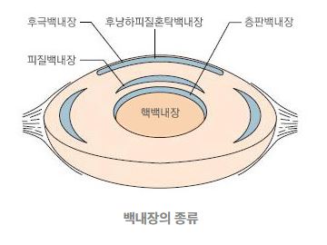 백내장 초기증상