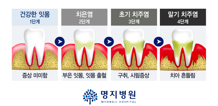 치은염-치주염의차이