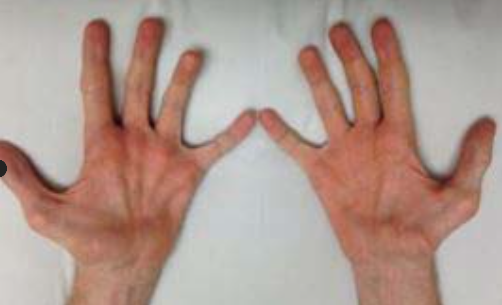 삼성가 이부진 사장 걸음걸이와 샤르코 마리 투스 유전병 팩트체크