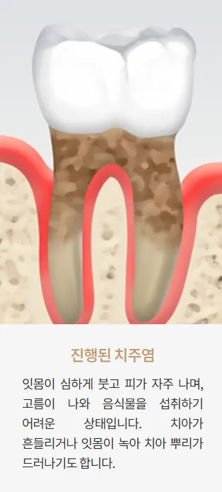 잇몸그래픽2