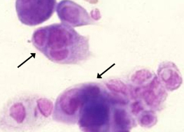 다핵거대세포 도말검사 사진