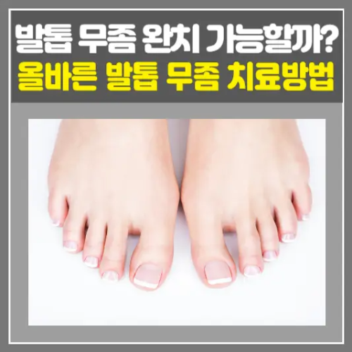 올바른 발톱 무좀 치료방법과 예방법 총정리 - 발톱 무좀 완치 가능할까요
