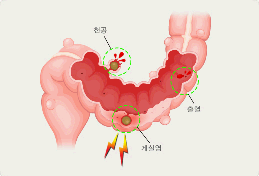 게실염-이미지