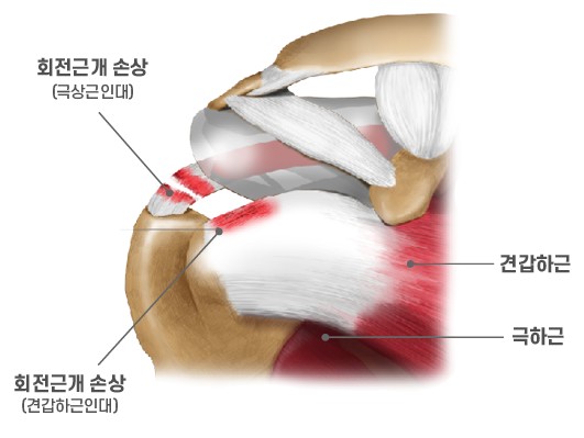 어깨회전근개 파열, 증상에 따른 치료방법