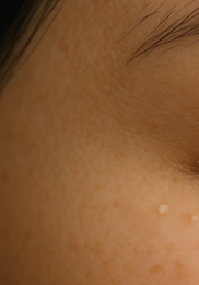 비립종 생기는 이유