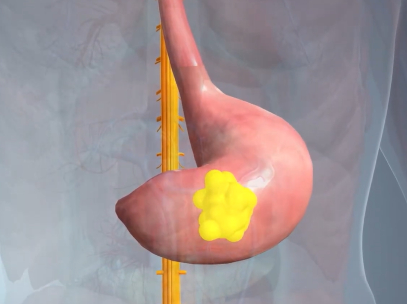 소화불량인 위 이미지