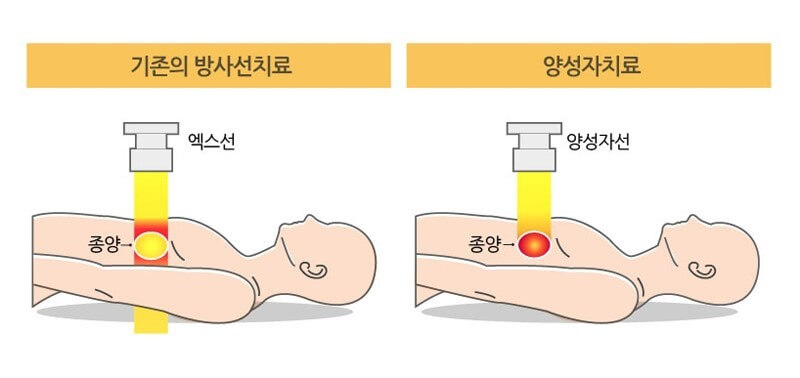 양성자 치료의 빔 조사범위
