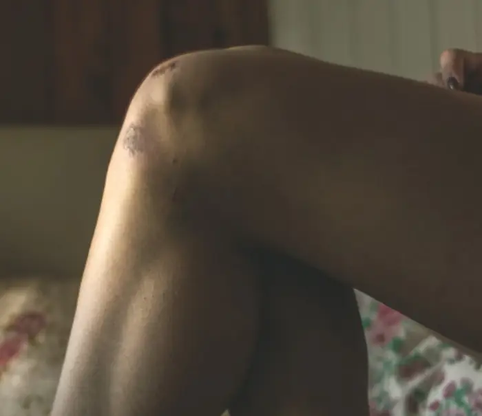 메디폼 교체시기