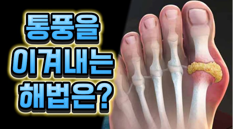 통풍-운세-해법