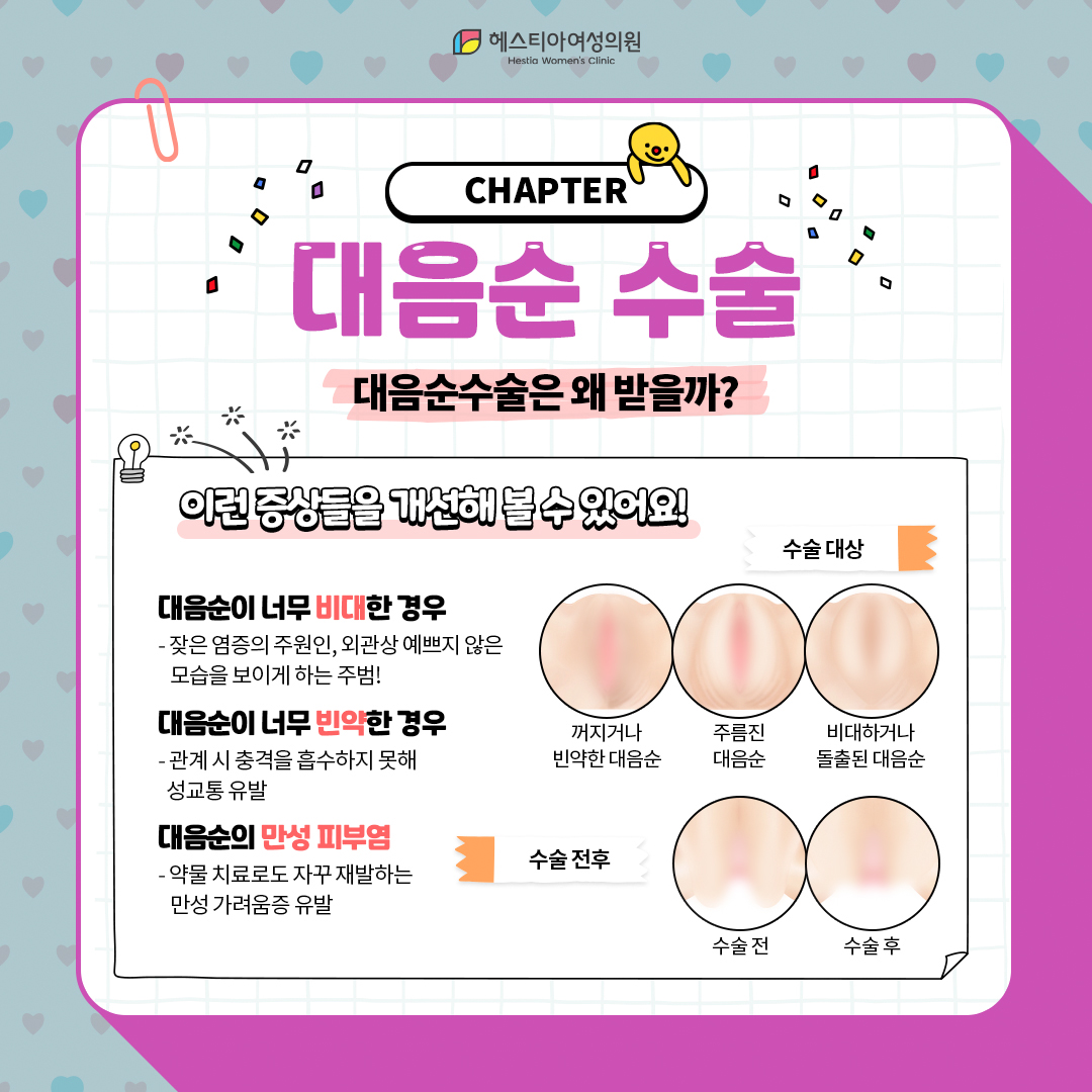 대음순수술은 왜 받을까?