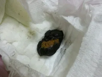 똥이 까만색 검정똥 원인과 질병 가능성_4
