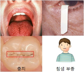 쇼그렌증후군 환자를 위한 산정특례 혜택 총정리(건강보험 혜택, 신청절차, 필요서류)