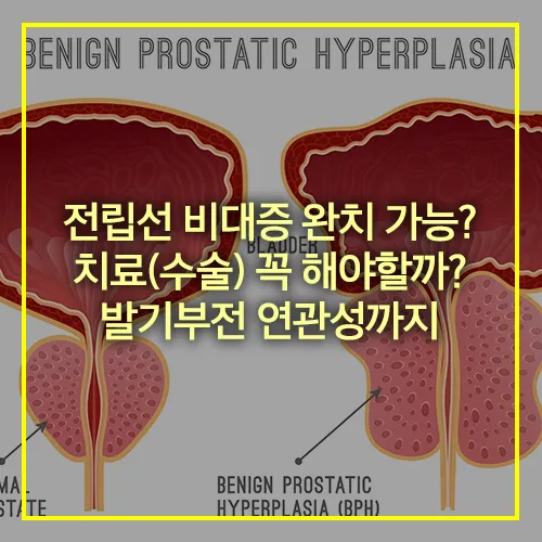 전립선 비대증 치료 발기부전 연관성
