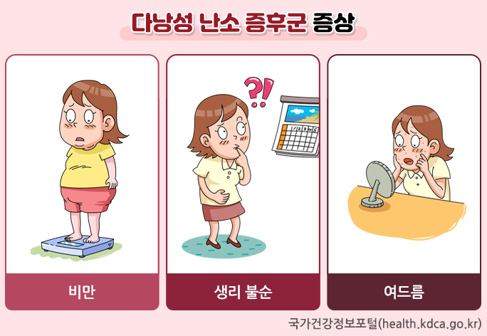 다낭성 난소 증후군 주요증상