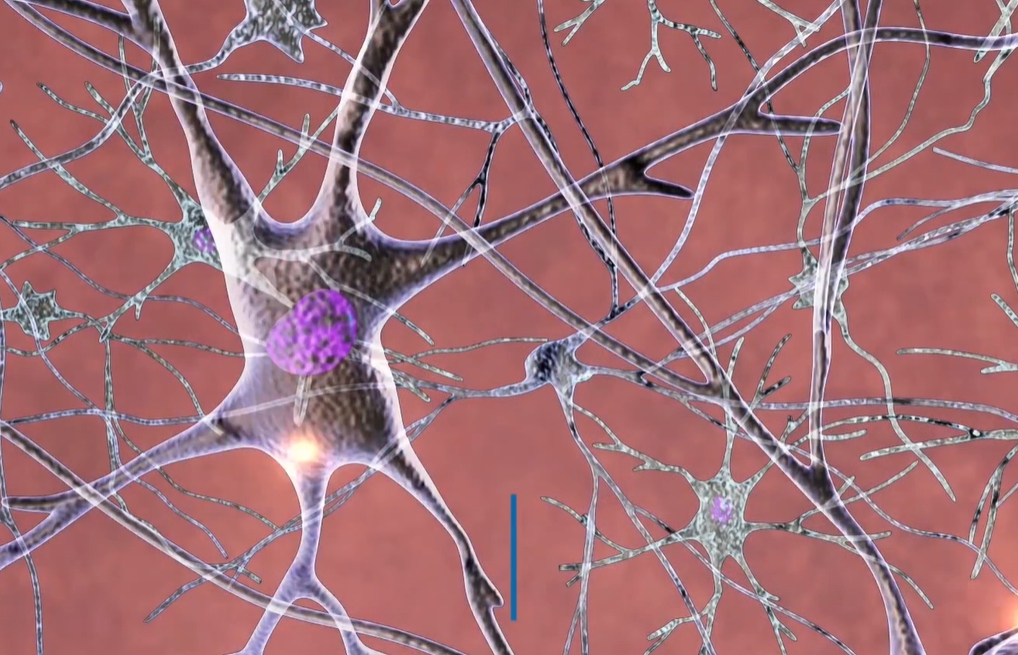 뇌경색 전조증상