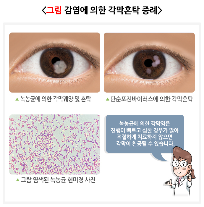 각막혼탁