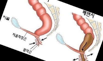 항문 찢어짐