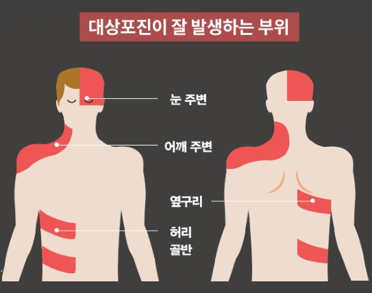 대상포진 발생부위 그림