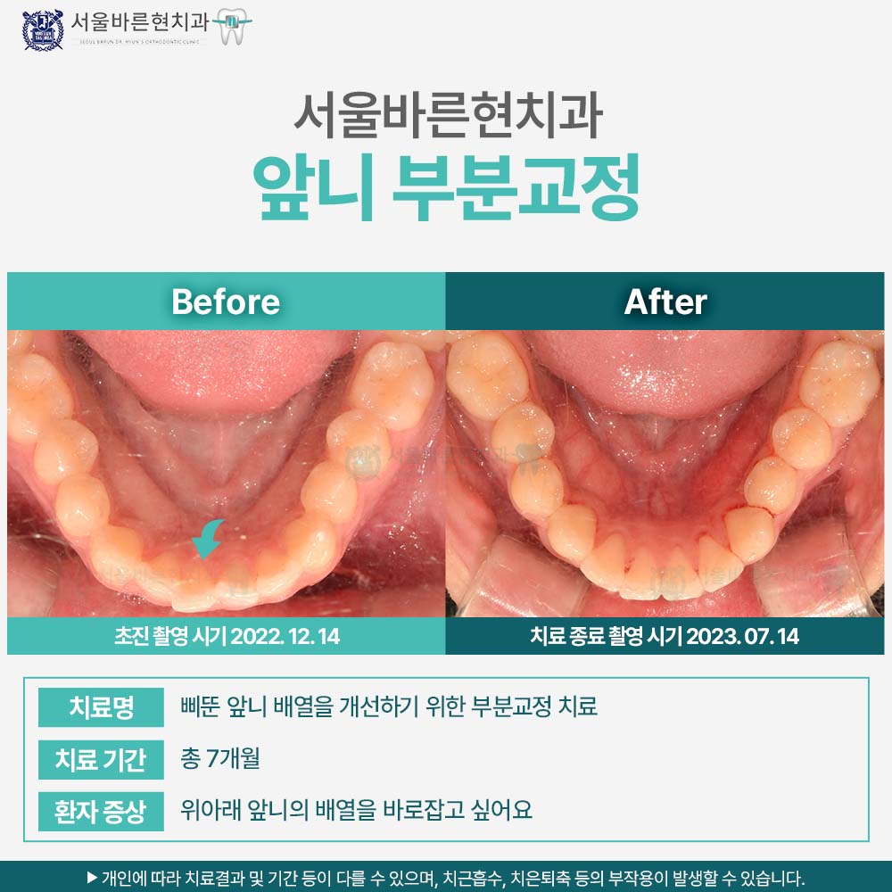 해운대치아교정