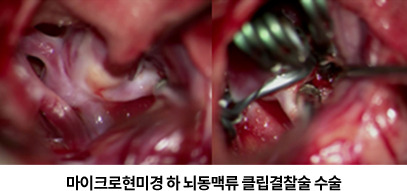 뇌동맥류 코일색전술