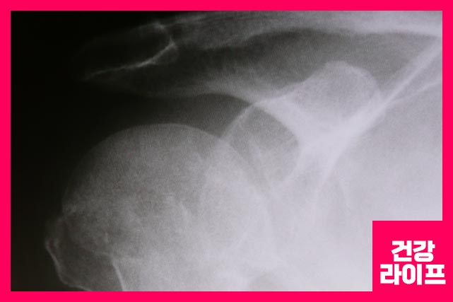 급성 손상 또는 만성 퇴행성의 두 가지 원인