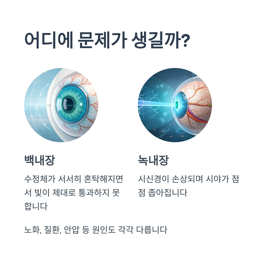 백내장과 녹내장 발생 부위 차이를 보여주는 눈 구조 비교