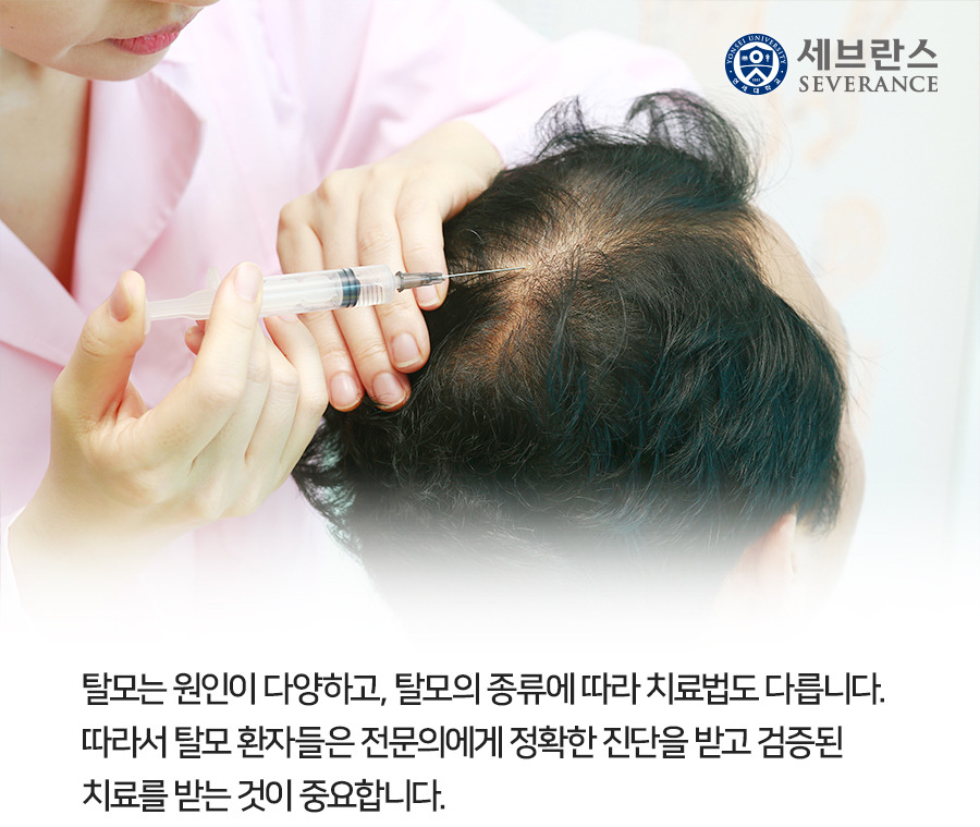 탈모 치료법