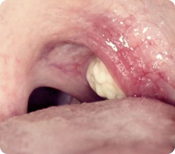 편도결석 제거기 사용 후기 및 방법