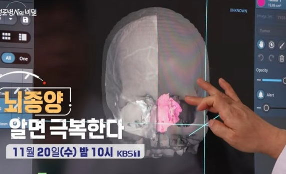 뇌종양알면극복한다