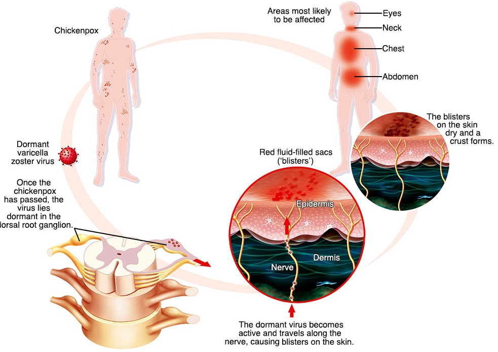 수포 없는 대상 포진의 효과적인 치료 방법