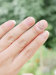 손톱과 갑상선 질환의 관계