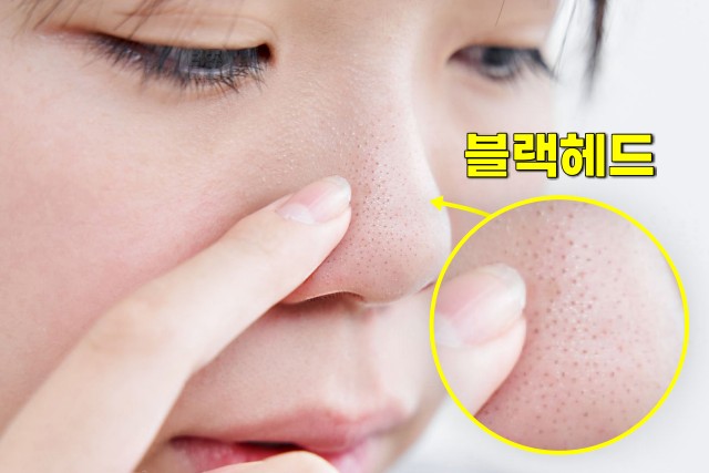 코 피지 제거법, 코 블랙헤드 없애는 방법, 팁줌