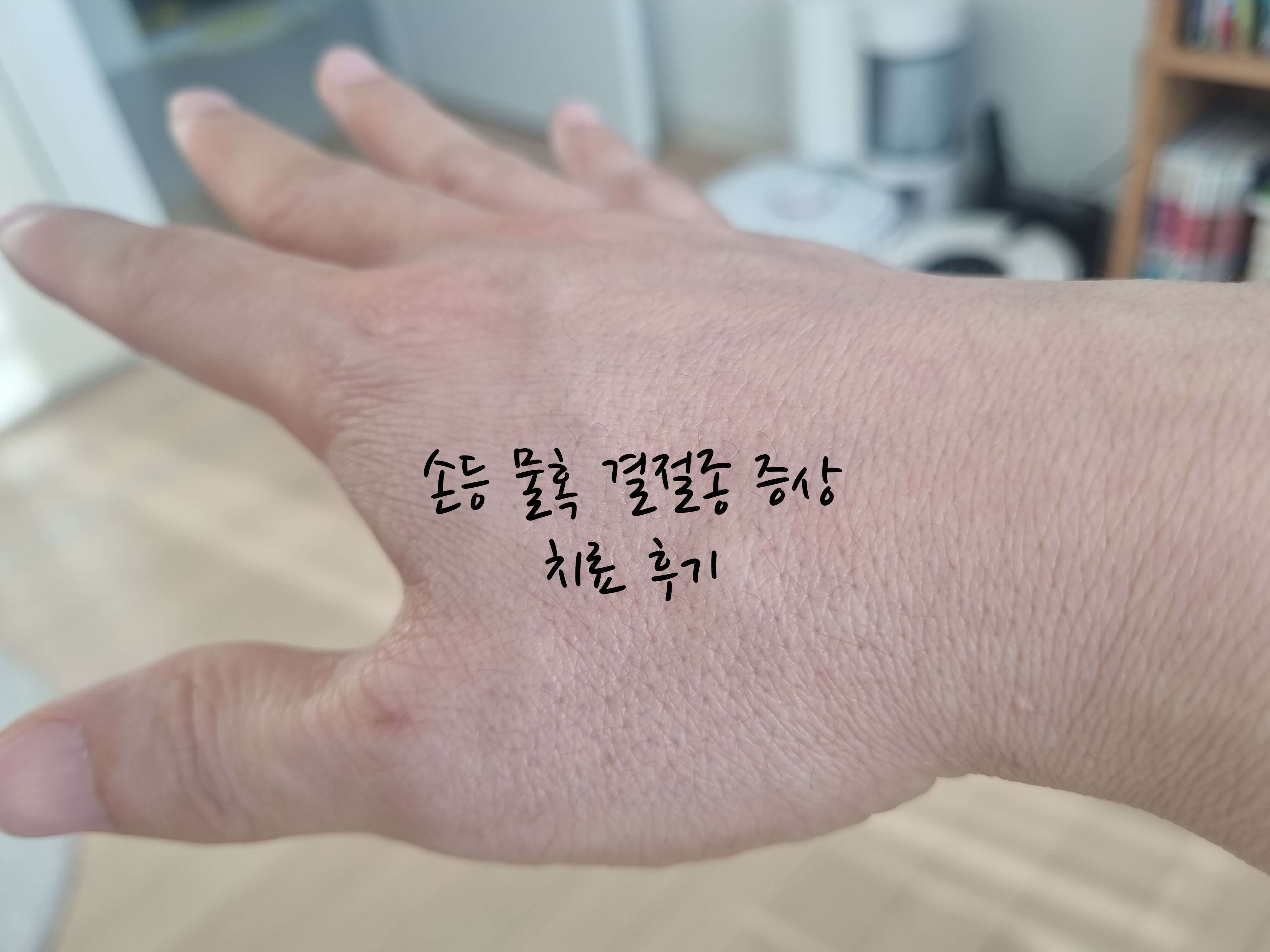 손등 물혹 결절종